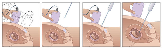 DNA血液测试，孕妇产检的新选择