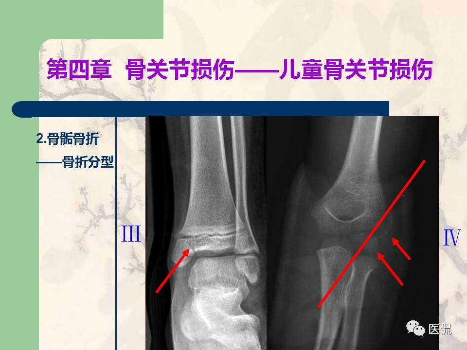 骨关节创伤x线诊断图谱,骨关节损伤x线图