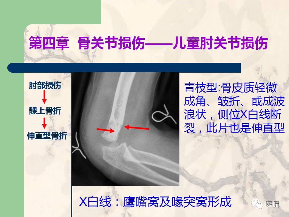 骨关节创伤x线诊断图谱,骨关节损伤x线图