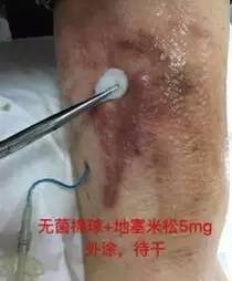 皮炎可以用的医用敷料,过敏性皮炎可以用医用敷料吗