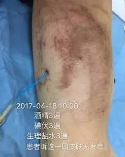 皮炎可以用的医用敷料,过敏性皮炎可以用医用敷料吗