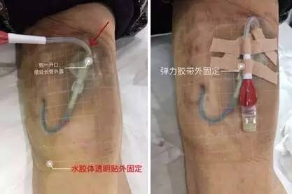 皮炎可以用的医用敷料,过敏性皮炎可以用医用敷料吗