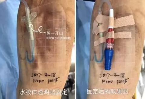 皮炎可以用的医用敷料,过敏性皮炎可以用医用敷料吗