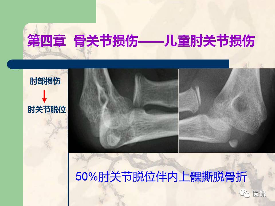 骨关节创伤x线诊断图谱,骨关节损伤x线图