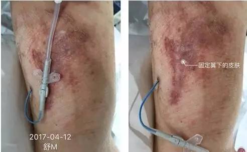 皮炎可以用的医用敷料,过敏性皮炎可以用医用敷料吗