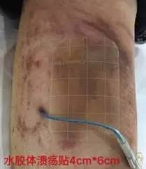 皮炎可以用的医用敷料,过敏性皮炎可以用医用敷料吗