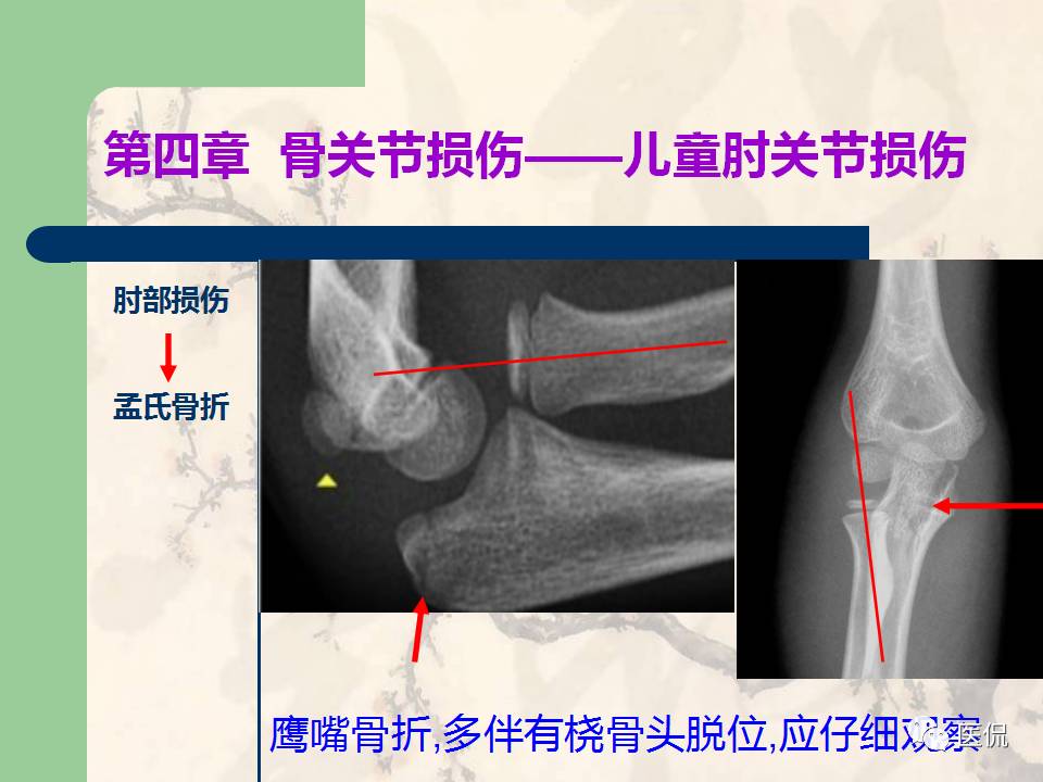 骨关节创伤x线诊断图谱,骨关节损伤x线图