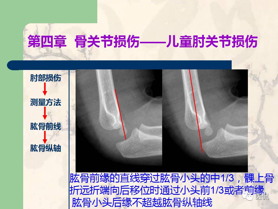骨关节创伤x线诊断图谱,骨关节损伤x线图