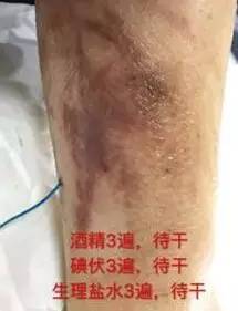 皮炎可以用的医用敷料,过敏性皮炎可以用医用敷料吗