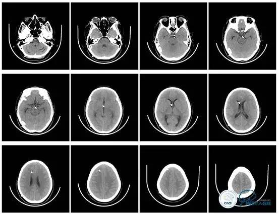 静脉窦狭窄支架植入术,静脉窦狭窄做支架多少钱
