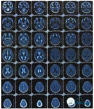 静脉窦狭窄支架植入术,静脉窦狭窄做支架多少钱