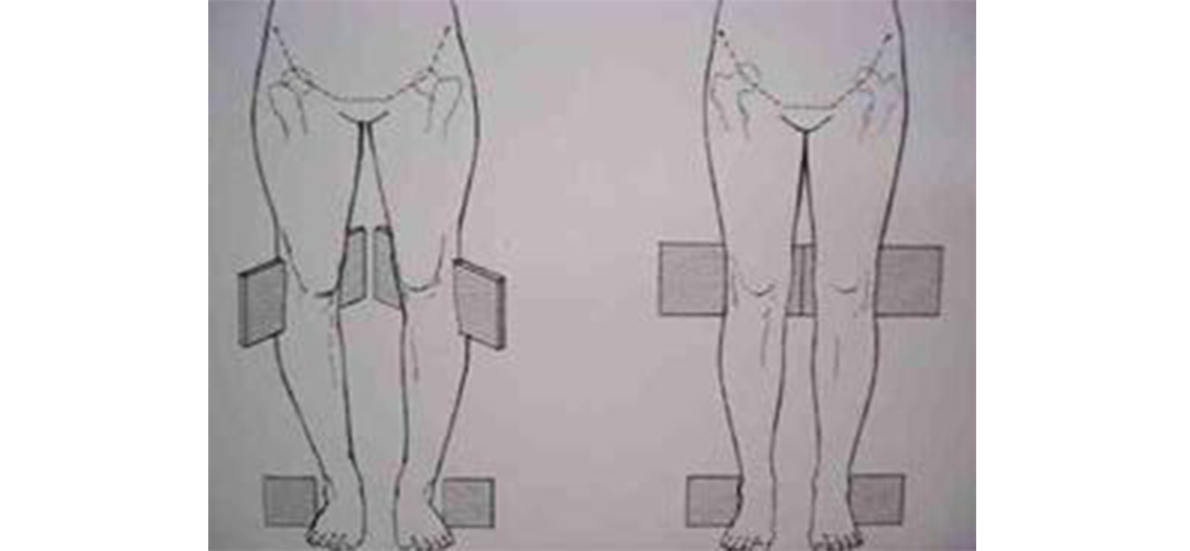 翘二郎腿导致腿部变形怎么矫正,翘二郎腿变形了有没有办法矫正