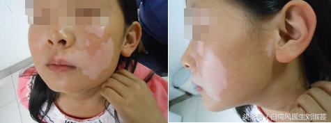 白癜风一年只吃一种药？还是三个月换一次药？长期固定or定期更换，白癜风资深专家给出这样的解释……