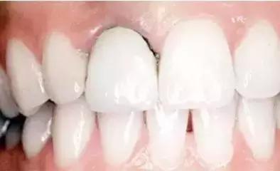 我的烤瓷牙,我的烤瓷牙20年了