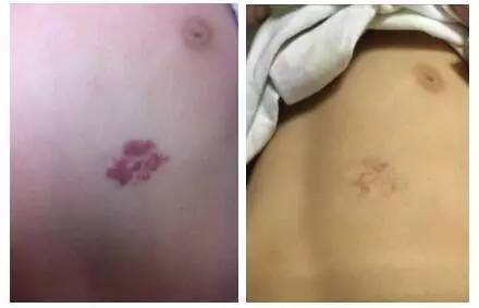 婴儿红色胎记怎么治最好的方法,治疗红胎记最先进的技术