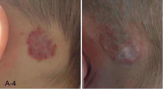 婴儿红色胎记怎么治最好的方法,治疗红胎记最先进的技术