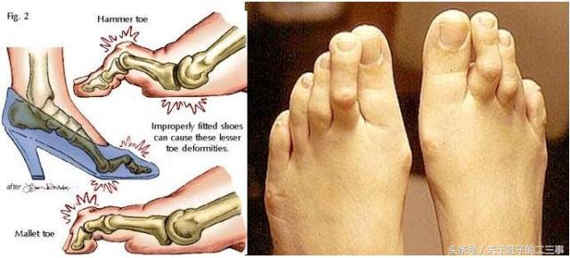 穿高跟鞋怎么保护脚趾头,高跟鞋防磨脚趾头方法