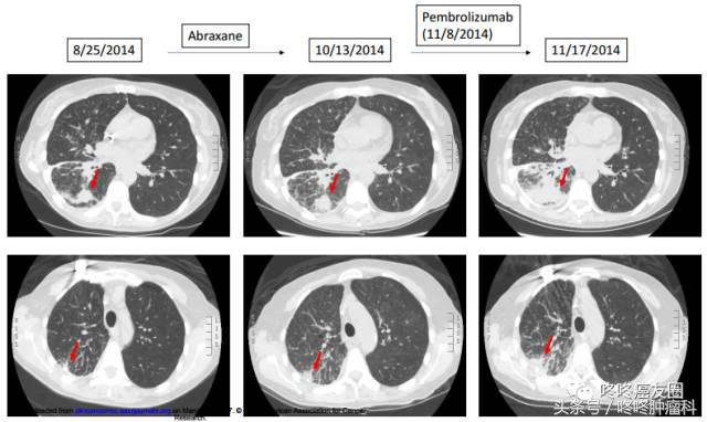 pd-1适用于每个人吗,如何知道pd-1是否适合