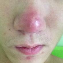 鼻子很油有痘怎么去,鼻子冒油长痘快速消除方法