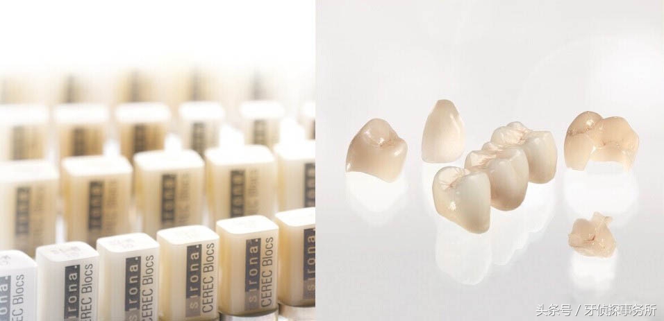 美学补牙和普通补牙区别,除了树脂补牙还有什么材料补牙