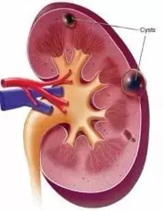 体检发现肾囊肿是什么征兆,体检发现肾囊肿该怎么办