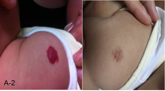 婴儿红色胎记怎么治最好的方法,治疗红胎记最先进的技术