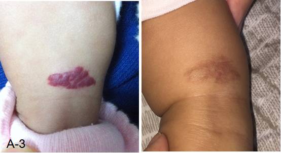 婴儿红色胎记怎么治最好的方法,治疗红胎记最先进的技术