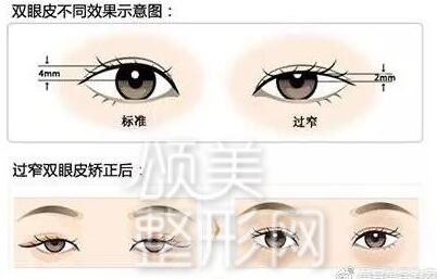 整形医院把双眼皮做失败了怎么办,埋线双眼皮失败后最佳修复时间