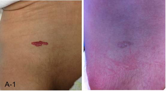 婴儿红色胎记怎么治最好的方法,治疗红胎记最先进的技术