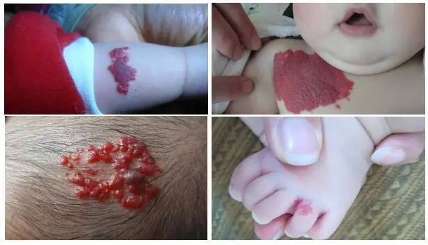 婴儿红色胎记怎么治最好的方法,治疗红胎记最先进的技术