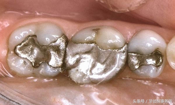 美学补牙和普通补牙区别,除了树脂补牙还有什么材料补牙