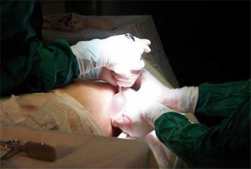 节育环还会过敏长到肉里面？到底该不该上环，看了以后真心疼女人！