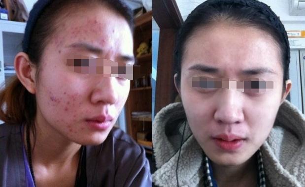 草莓鼻毛孔粗大生活妙招,怎么改善草莓鼻毛孔粗大