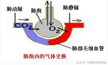 肺心病二氧化碳高如何排出,肺心病人二氧化碳潴留怎么办