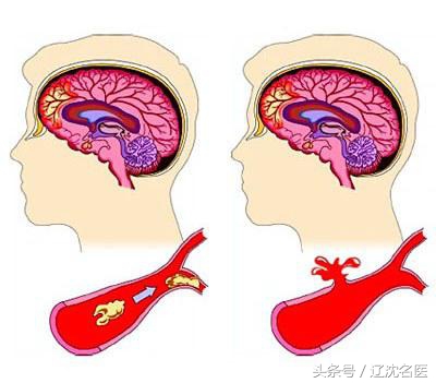 脑出血脑梗特效药,脑梗病人如何进行溶栓治疗