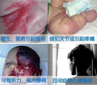 婴儿红色胎记怎么治最好的方法,治疗红胎记最先进的技术