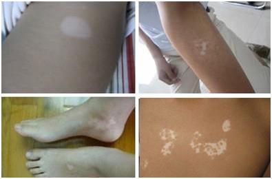 白癜风季节,为什么秋季不能治疗白癜风