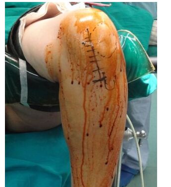 半夜半月板损伤膝盖有积液,膝盖半月板损伤要怎么治