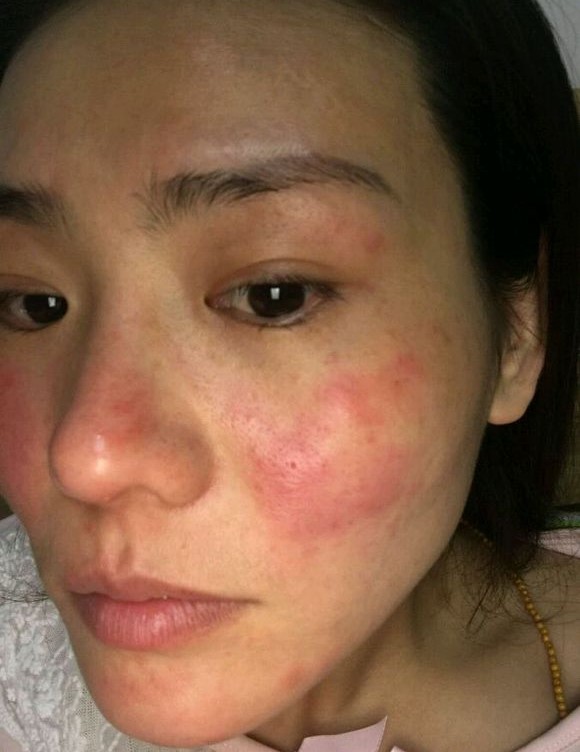 扑尔敏能改善大红脸吗,脸过敏吃扑尔敏多久有效