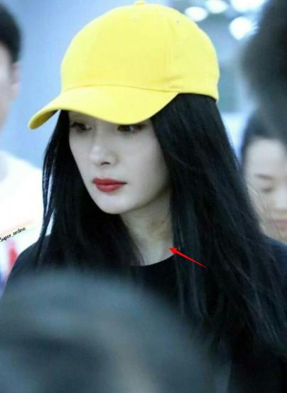 杨幂中医视频,杨幂针灸放血治疗