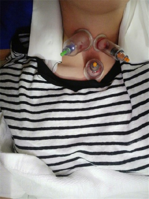 杨幂脖子前后对比,杨幂吻痕