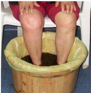 血友病患者关节肿痛，长时间不消肿，怎么办？