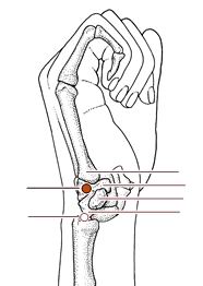 心烦失眠针灸,心烦针灸哪个穴位