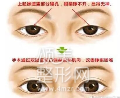 整形医院把双眼皮做失败了怎么办,埋线双眼皮失败后最佳修复时间