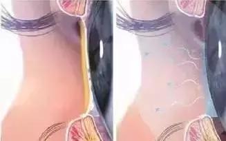 干眼症能工作吗,神经性干眼症自救