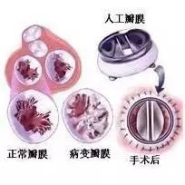 心脏瓣膜置换术费用医保报销多少,心脏瓣膜置换手术一般能活多少年