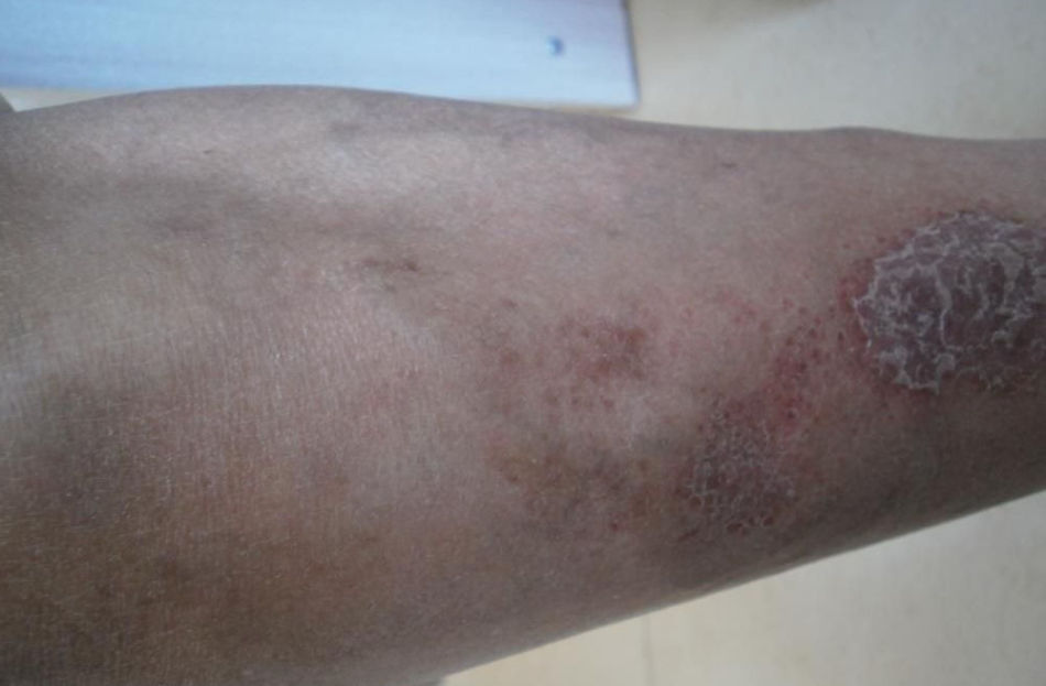 湿疹几十年了都治不好怎么办,湿疹10年了