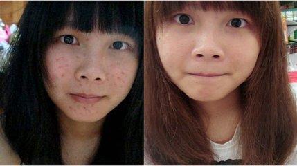 痘痘清洁护肤步骤,痘痘肌肤的最佳修复方法