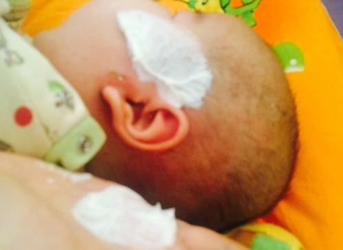 润肤霜能治疗成人湿疹吗,皮肤科博士推荐100元护肤品