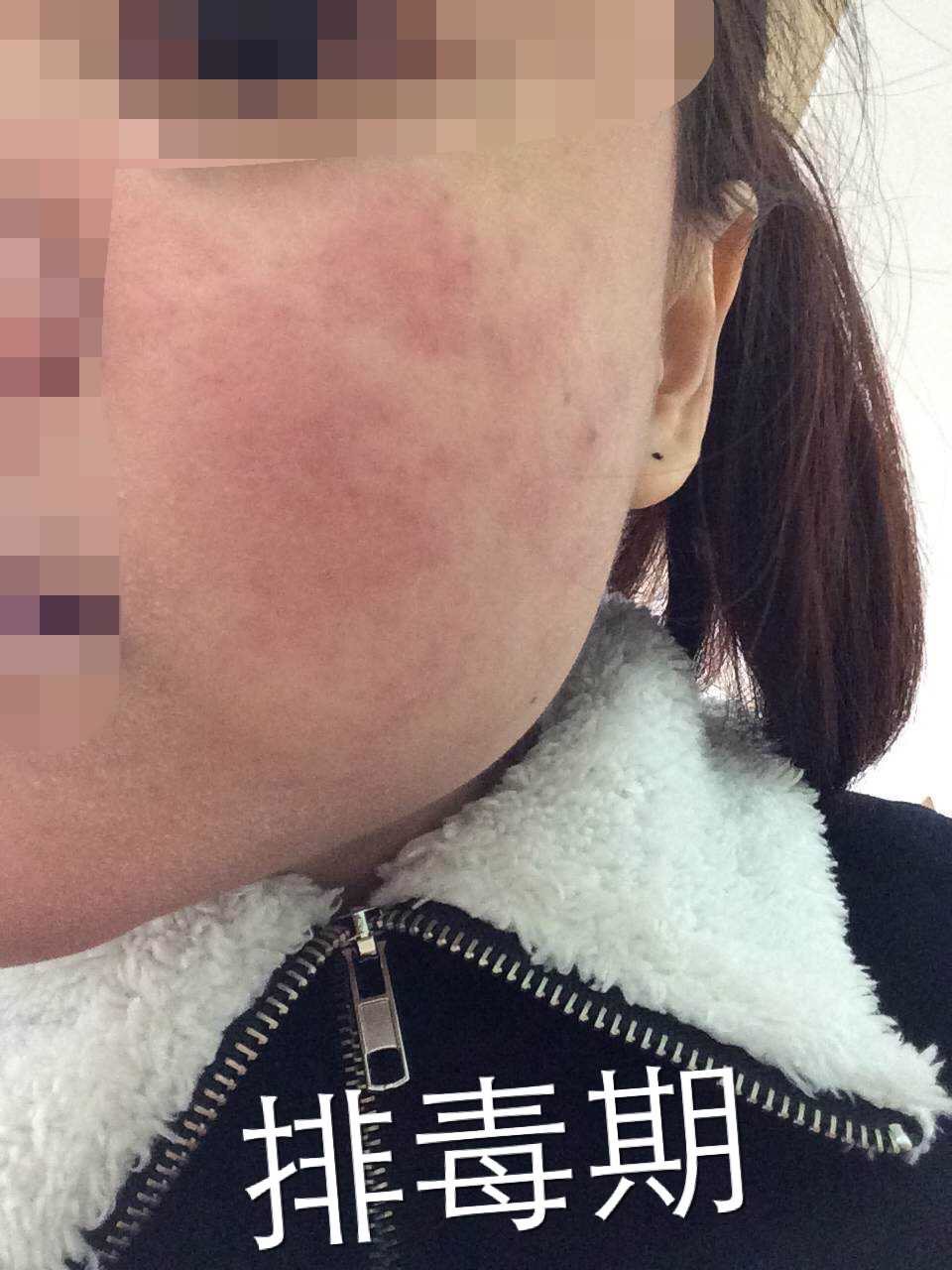 慎入！春季多发激素脸！你还要不要脸？